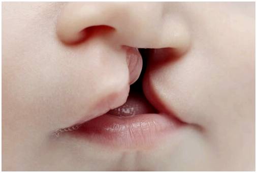 В каком возрасте можно делать операцию ребенку с заячьей губой?