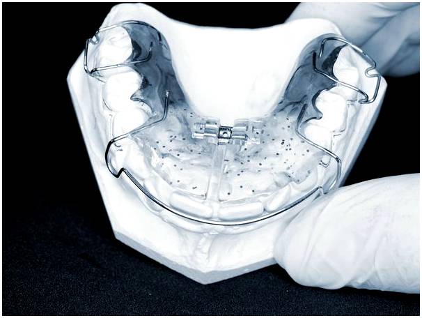 Интерцептивная ортодонтия: что это такое и в чем польза для детей?