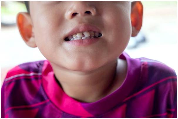 Скученность зубов у детей: как это исправить?