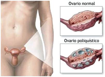 Синдром поликистозных яичников и беременность
