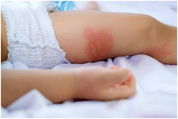 Контактный дерматит у детей: симптомы, причины и лечение