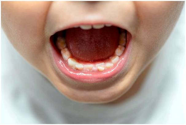 Неправильные зубы у детей: что делать?
