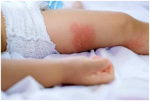 Аллергические тесты у детей: из чего они состоят?