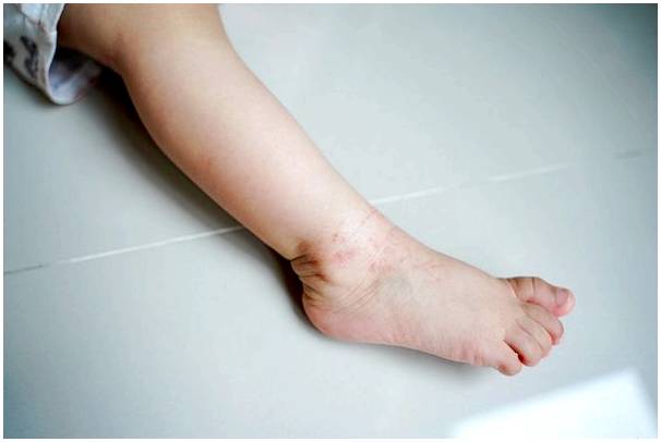 10 самых распространенных кожных заболеваний у детей
