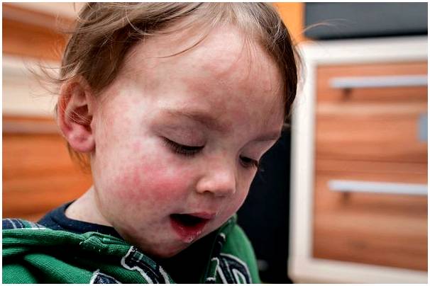 Аллергия на ЛТП у детей