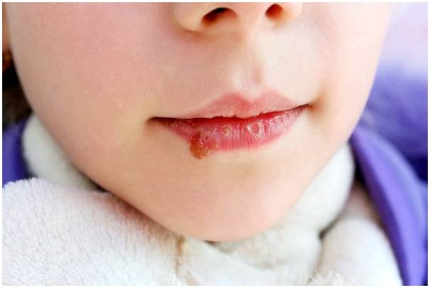 Кандидоз полости рта у детей: симптомы, причины и лечение