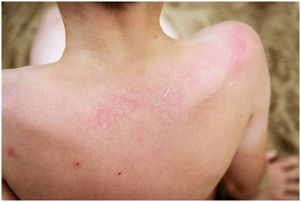 Рак кожи у детей: симптомы, причины и лечение